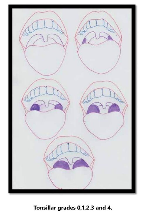 Tonsillar grades 0, 1, 2, 3 and 4